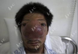 Man with nose carcinoma