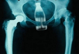 What should i extract from this x-ray?