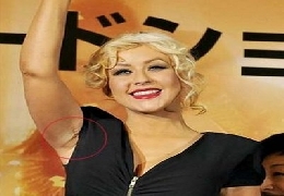 Famous plastic surgery victims